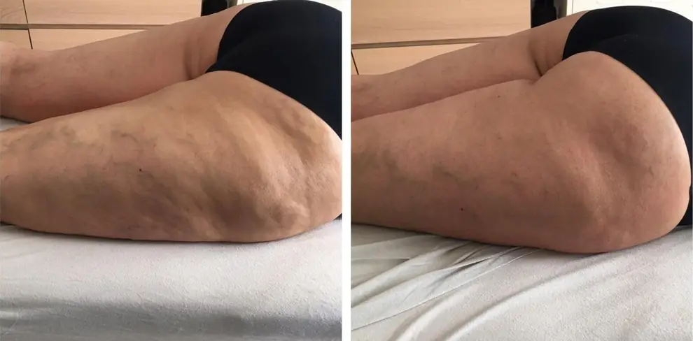 Avant et après de la cuisse, texture de peau, même appui.
