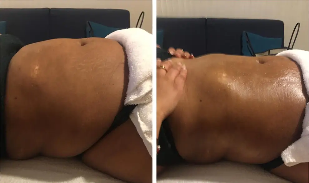 Avant et après du fessier et de la hanche, allongée sur le côté.