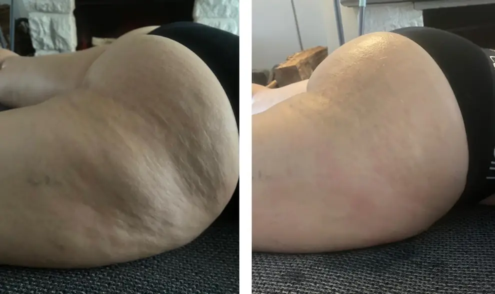 Avant et après sur la hanche, même position et même lumière.