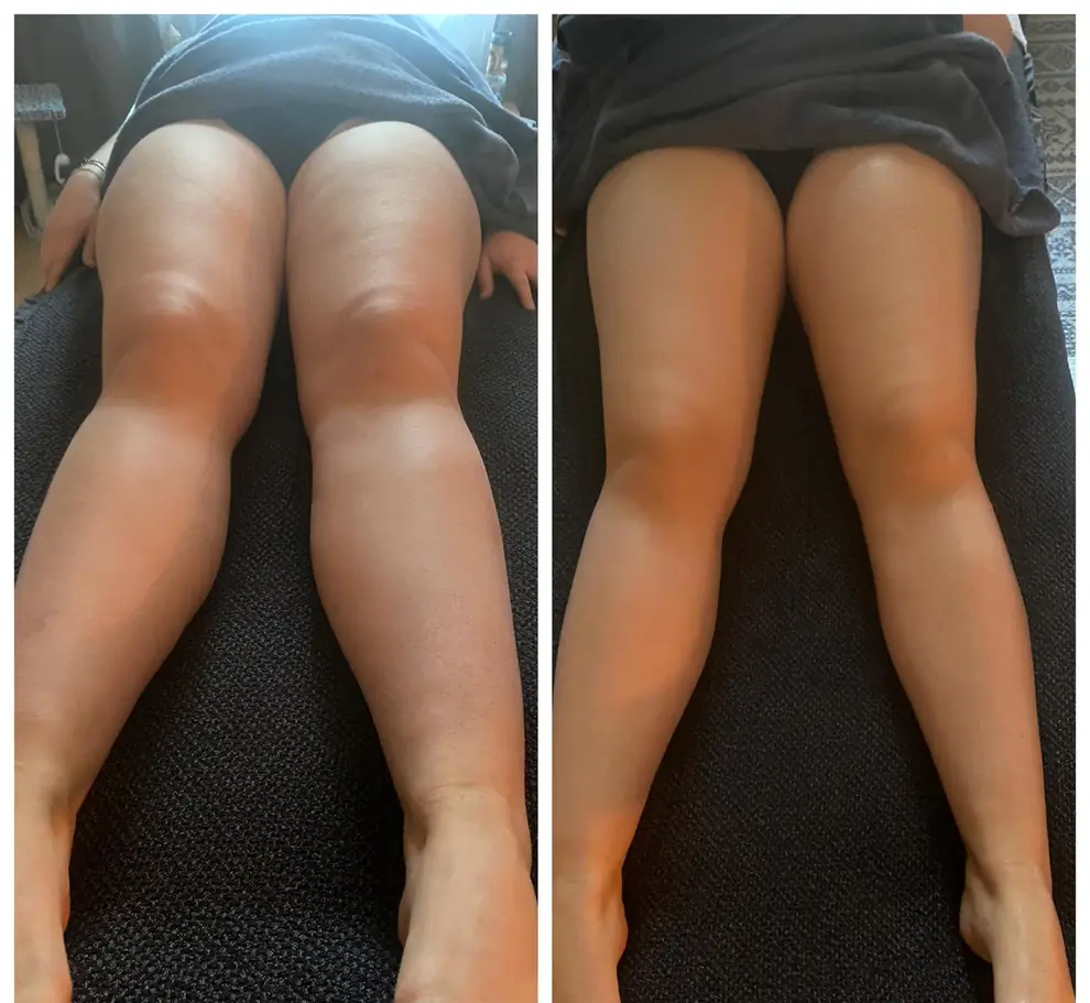 Avant et après des jambes vues de face, allongée, même cadrage.