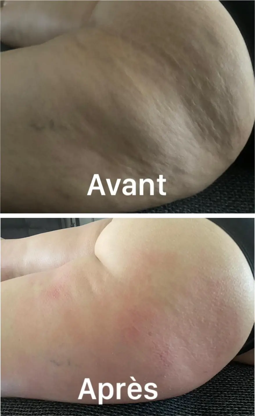 Avant et après sur la hanche et la cuisse, texture de peau, à deux séances d’écart.